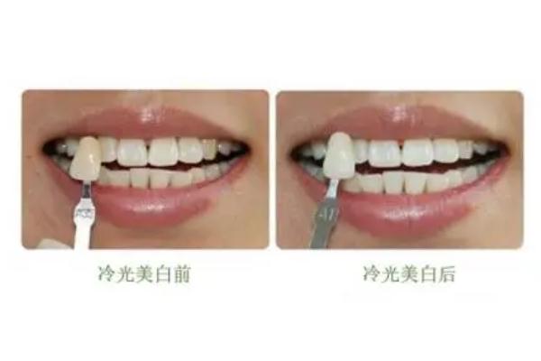 冷光美白牙齿可以白到啥程度 冷光美白牙齿可以做几次