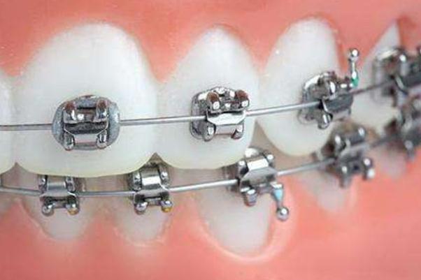 牙套是上下牙一起戴吗 牙套是怎么矫正牙齿的