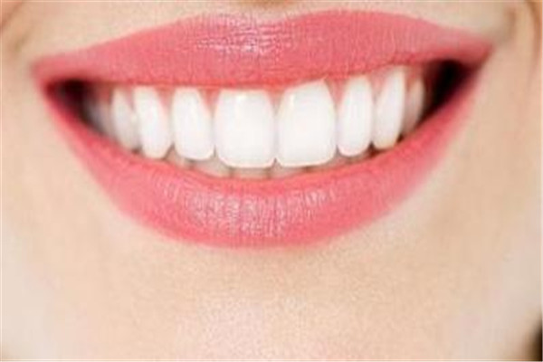 牙齿贴面多少钱 根据不同的类型来定价