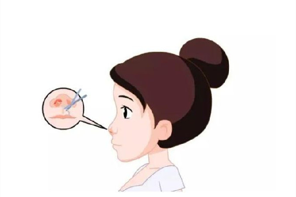 武汉玻尿酸整鼻子能坚持多久 武汉隆鼻去哪里比较好