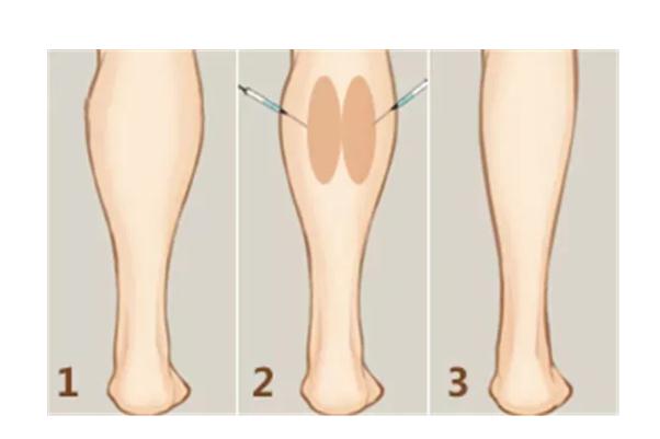 瘦腿针的原理 瘦腿针的危害有什么副作用