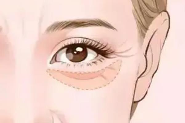 去眼袋手术可以保持多久 去眼袋手术可以去除眼睛下面皱纹吗
