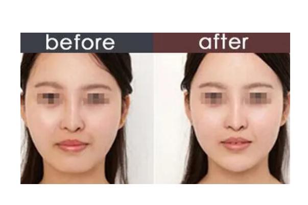 玻尿酸填充下巴多久定型 玻尿酸填充下巴多久可以化妆
