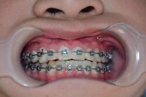 牙套什么年龄戴合适 牙套的作用是什么