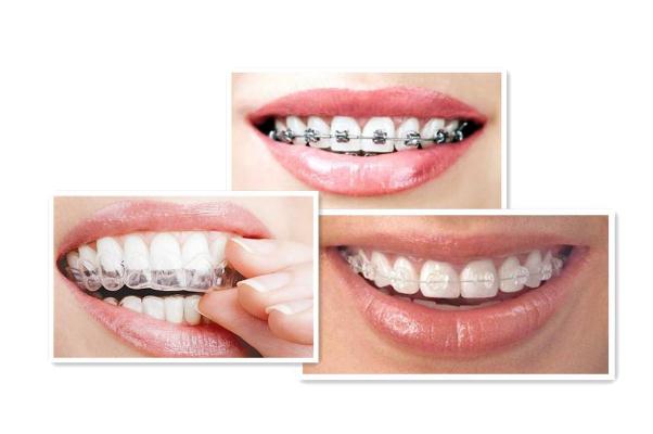 牙套什么年龄戴合适 牙套的作用是什么